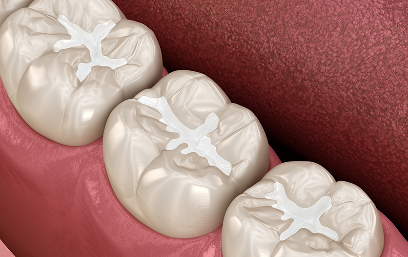 Image of multiple molars with fillings