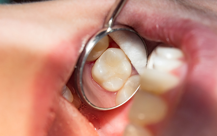 Image of person's teeth being inspected by dentist