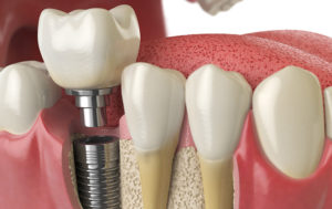 Illustration of dental implant alongside healthy teeth