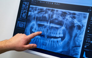 Dentis pointing to patient's x-ray