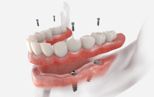 Model of overdentures