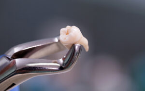 Dental pliers holding extracted tooth
