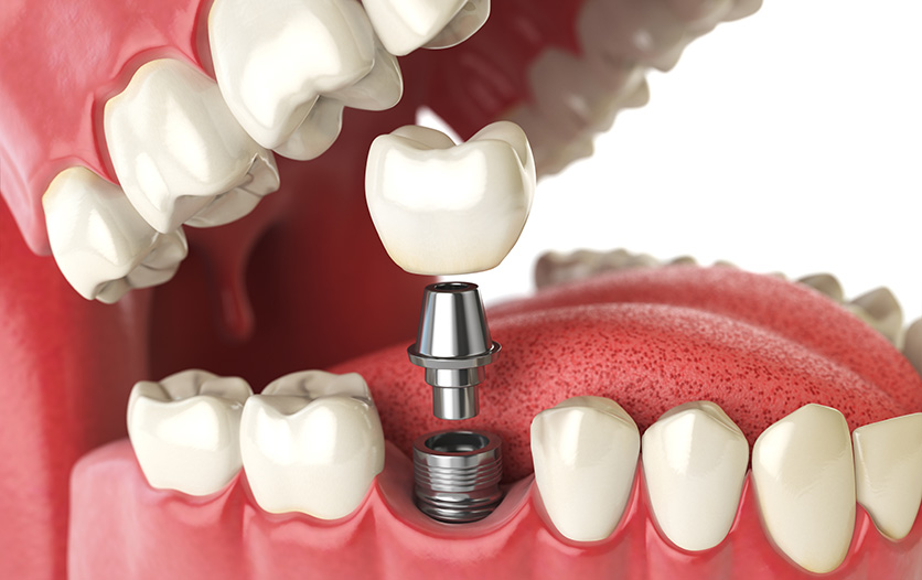 Illustration of each part of a tooth implant