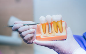 Dentist holding dental implant model