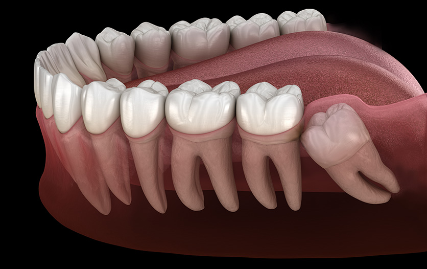 Impacted wisdom tooth